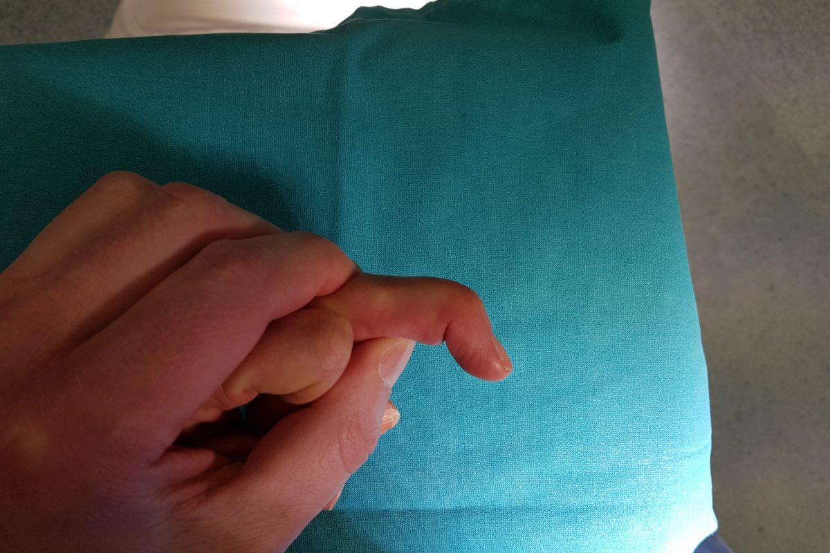 Mallet Finger (lesione di Segond)